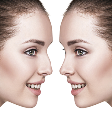 Female nose before and after cosmetic surgery