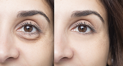 Woman eye before and after cosmetic treatment with and without e