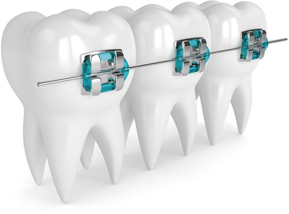 3d render of teeth with braces